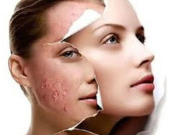 acne treatment glasgow