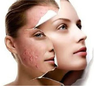 acne treatment glasgow